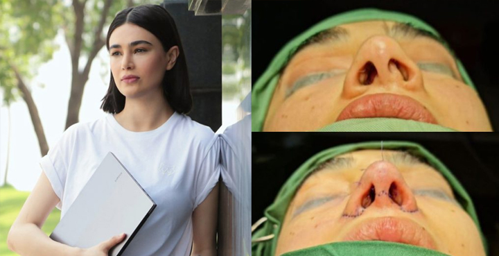 Saheefa Jabbar Khattak undergoes painful nose surgery
